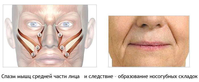 Образование носогубных морщин